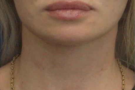 Шея пациентки после хирургического лифтинга, вид спереди