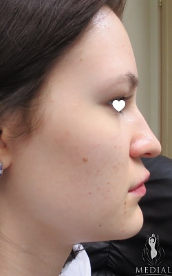 Общая коррекция носа + Булхорн фото до и после. Возраст пациента 22