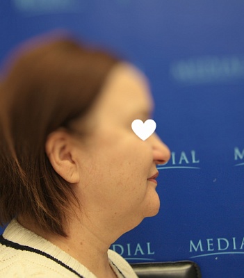 Комплексное омоложение лица и шеи  фото до и после. Возраст пациента 57 лет
