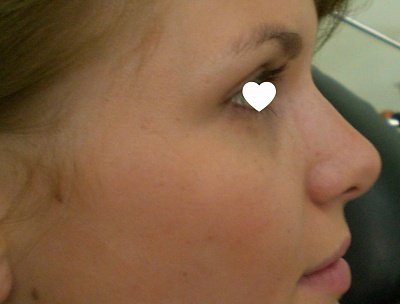 Хирургическая коррекция носа