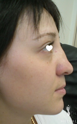 Операция по восстановлению носового дыхания фото до и после. Возраст пациента 26