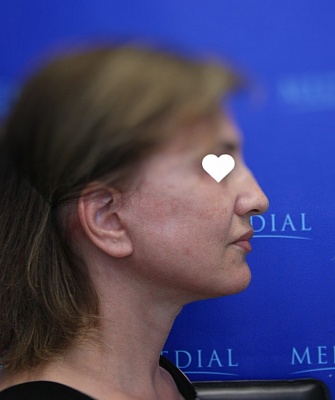 Комплексное омоложение лица и шеи фото до и после. Возраст пациента 58 лет
