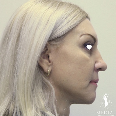 Объемная коррекция формы лица фото до и после. Возраст пациента 50