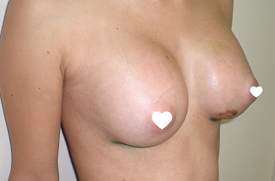 Увеличение груди пример 5