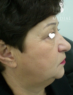 Комплексное омоложение лица и шеи + лазерная липосакция фото до и после. Возраст пациента 62