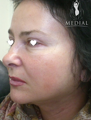 Комплексное омоложение лица и шеи + коррекция области под подбородком фото до и после. Возраст пациента 57