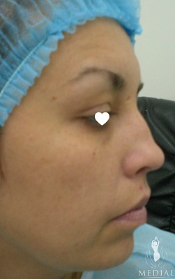Коррекция носа с восстановлением дыхательной функции фото до и после. Возраст пациента 37